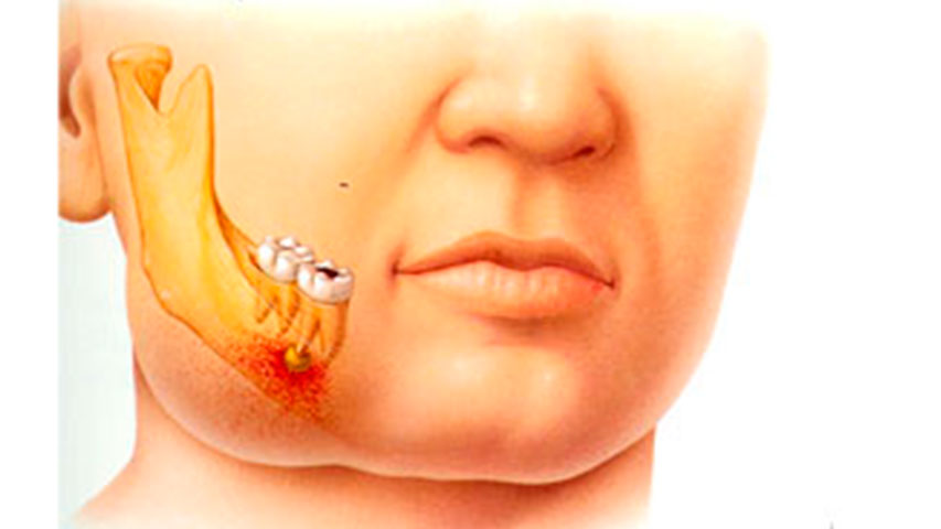 ¿Qué es la celulitis facial?